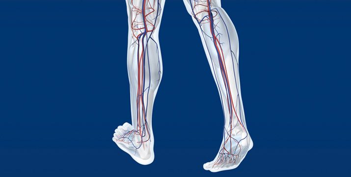 Kompressionstherapie bei CVI und pAVK