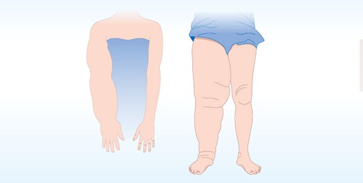 Lymphödem: Diagnose und Therapie
