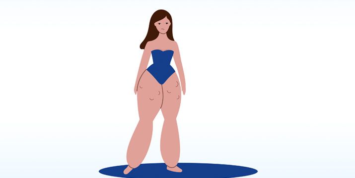 Diagnostik und Therapie des Lipödems